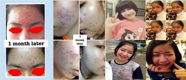 สิวอุดตัน สิวอุดตัน